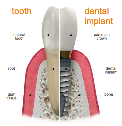 Tooth vs Dental Implant