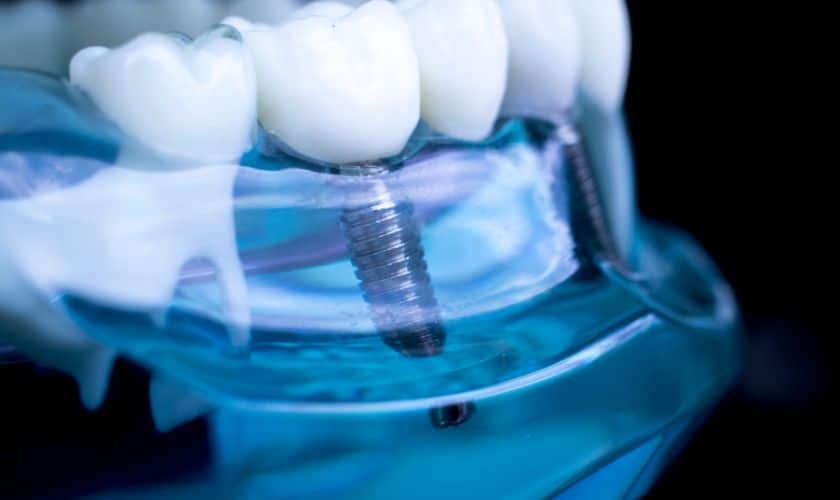 Dental Implants: A Permanent Solution for Missing Teeth in Windsor