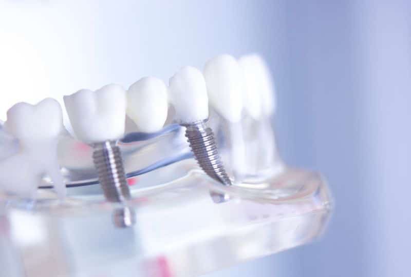 What Are the Essential Aftercare Tips for Dental Implants?