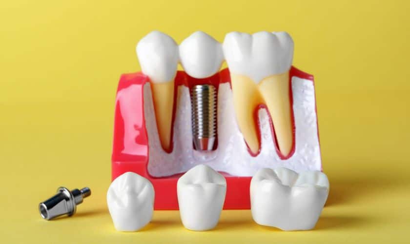 Can dental implants improve the aesthetics of a person’s smile?