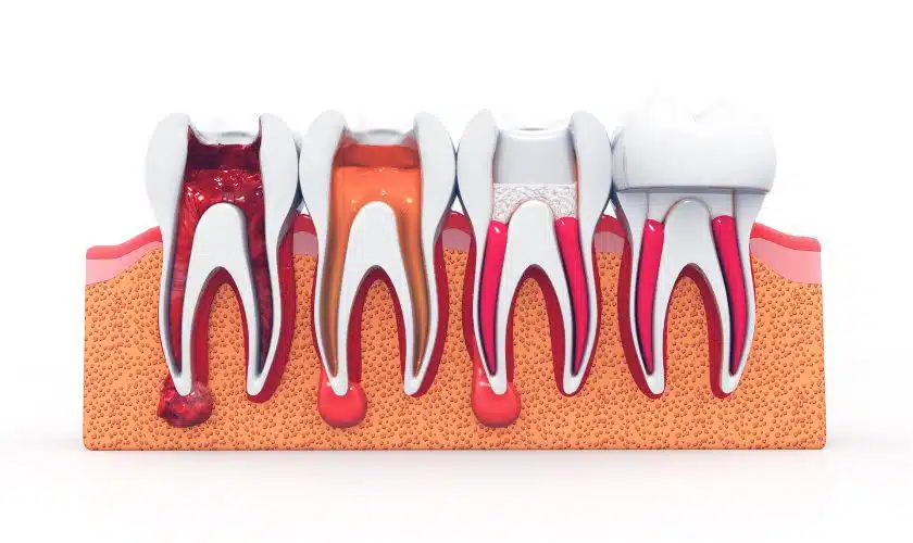 Caring for Your Teeth After Root Canal: Post-Treatment Oral Hygiene