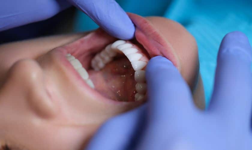 Understanding the Impact of Veneers on Your Dental Health